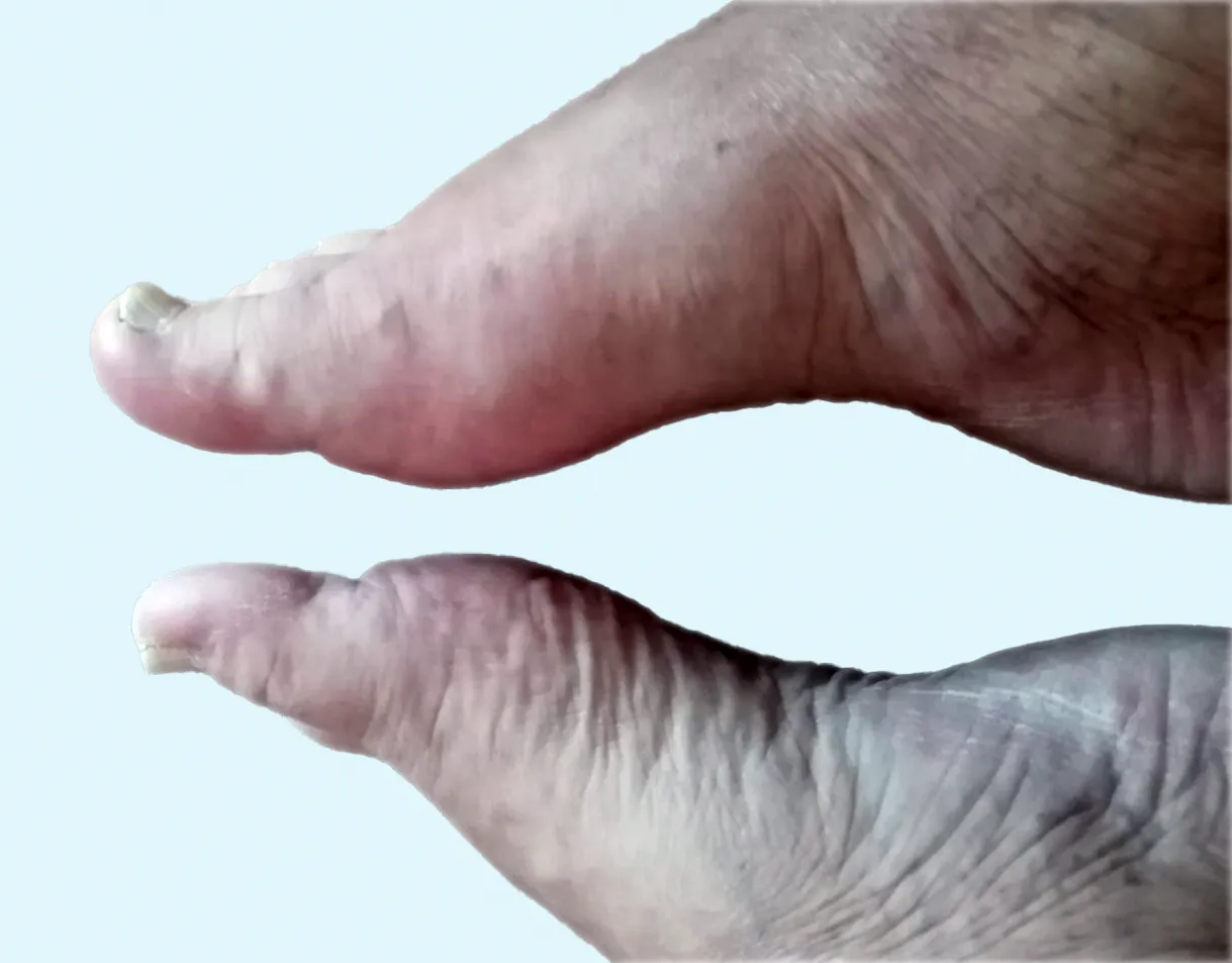 Uric arthritis