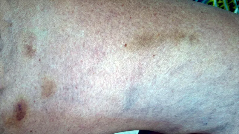 ssri bruises