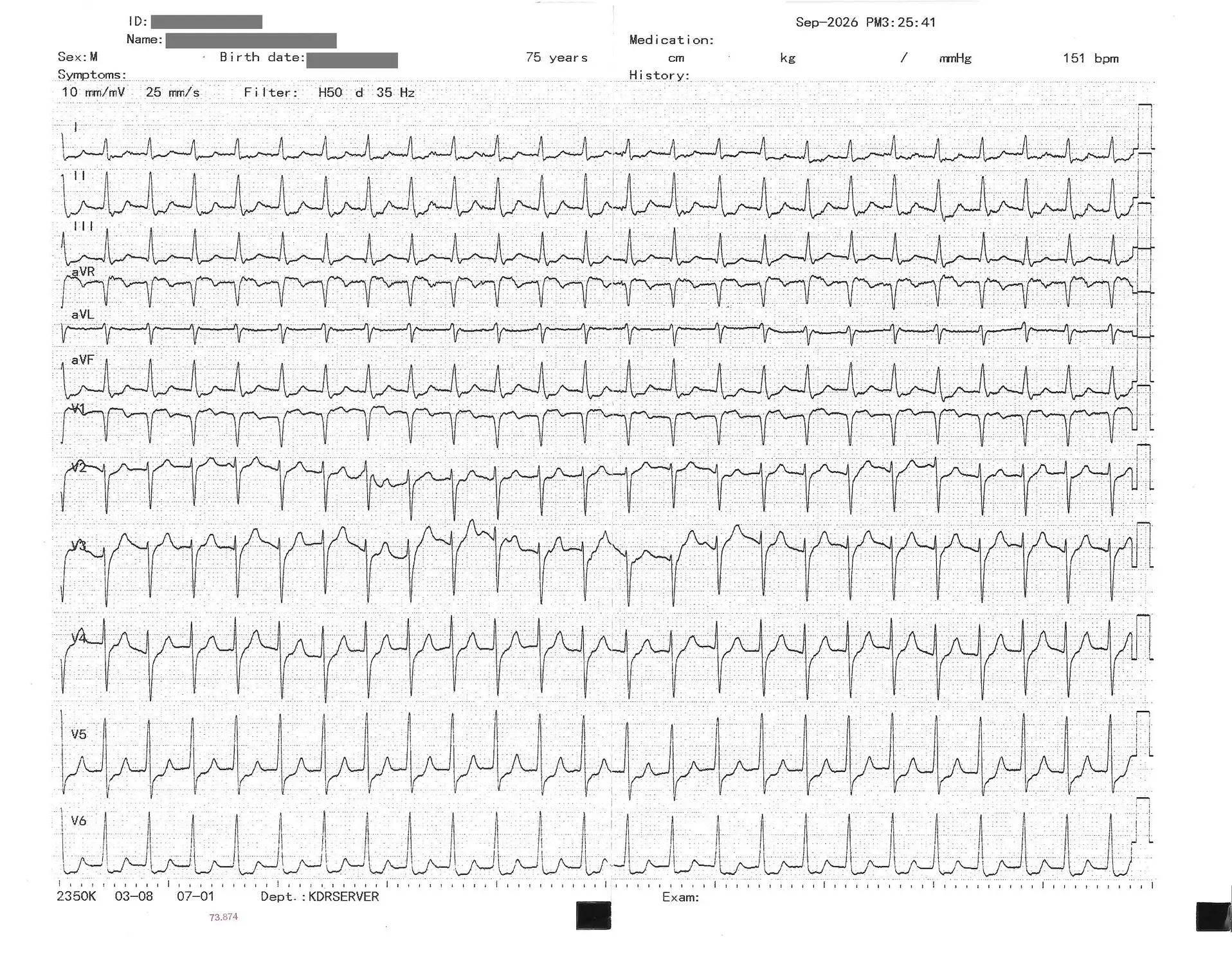 yperkoiliaki tachycardia